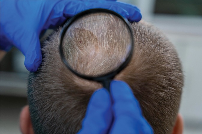 Alopecia Areata